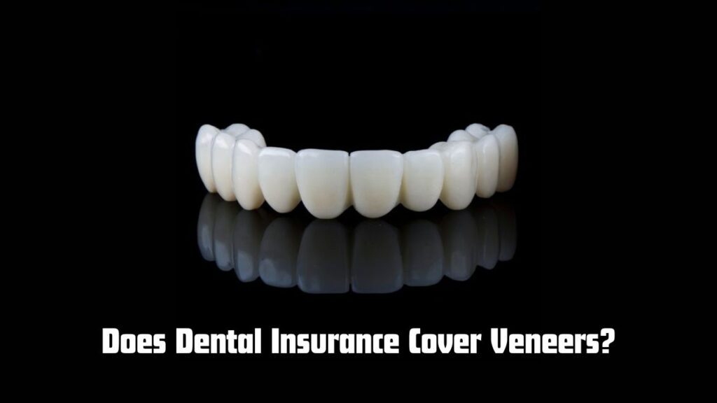 Does Dental Insurance Cover Veneers?